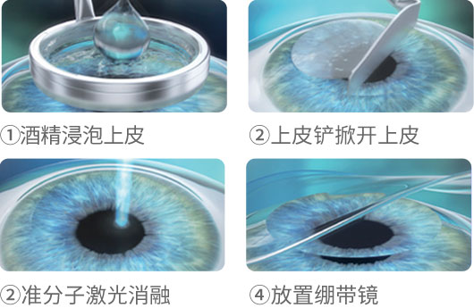 準分子激光近視手術